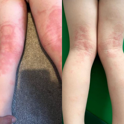 eczema