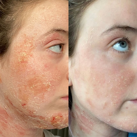 topical steroid withdrawal