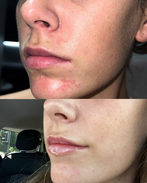 peri-oral dermatitis