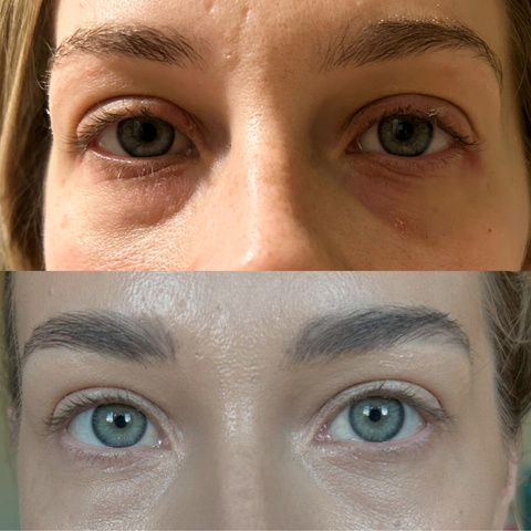 eyelid eczema